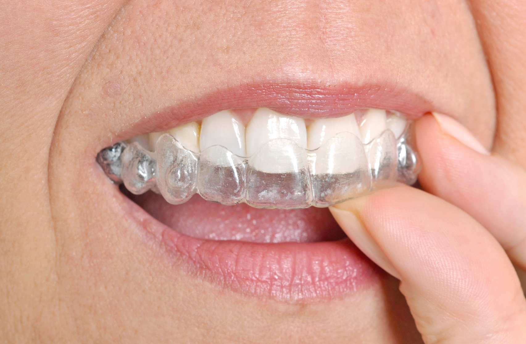 invisible braces 